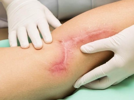 دل کے دوروں کے سبب پہنچنے والے نقصانات کی تلافی کرنے والا بائیو جیل
