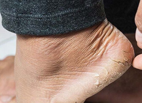 ایڑھیاں کیوں پھٹتی ہیں؟ گرمیوں میں پھٹی ایڑھیوں سے نجات کے آسان طریقے