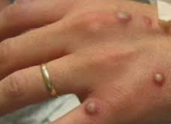 لاہور میں منکی پاکس کا پہلا کیس رپورٹ ہوگیا