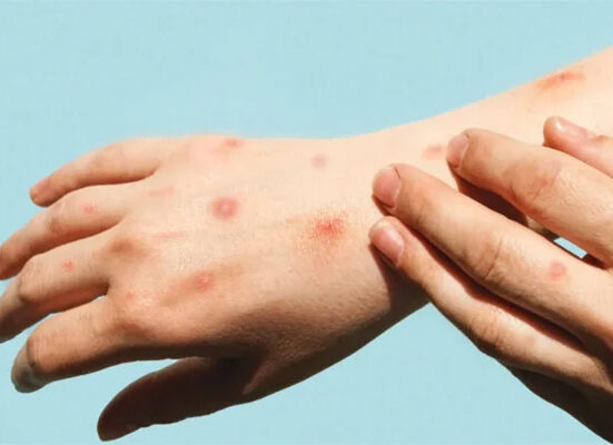 منکی پاکس ، بیرون ملک سے آنیوالی 9 سالہ لڑکی ،16 سالہ نوجوان مشتبہ مریض قرار