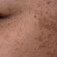 جلد کے سیاہ دھبے کیا بتاتے ہیں؟ ماہرِ غذائیت نے ہائپرپگمنٹیشن کی اصل وجوہات بتا دیں