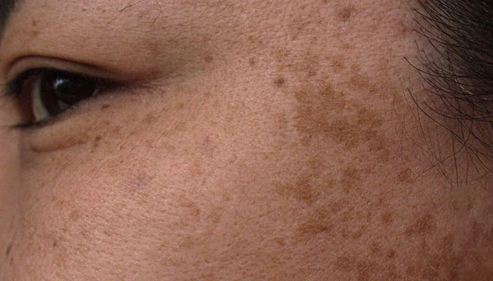 جلد کے سیاہ دھبے کیا بتاتے ہیں؟ ماہرِ غذائیت نے ہائپرپگمنٹیشن کی اصل وجوہات بتا دیں