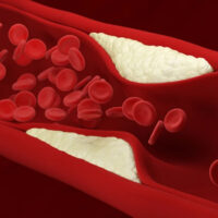 شریانوں میں جمی چکنائی کو کیسے دور کیا جائے؟