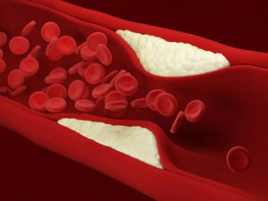 شریانوں میں جمی چکنائی کو کیسے دور کیا جائے؟