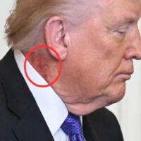 ٹرمپ کی گردن پر سرخ نشان، ڈاکٹر نے بالآخر سب کچھ بتا کر حیران کن حقیقت فاش کر دی